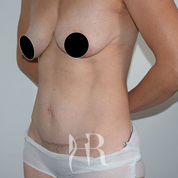 HR Plastic Surgery - Mini Tummy Tuck patient after 5